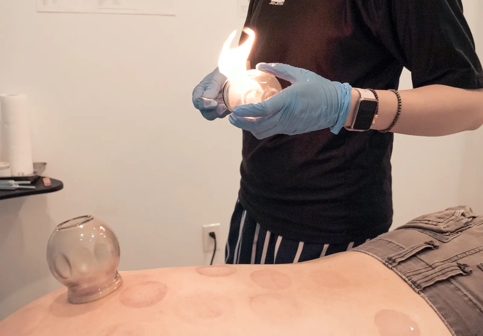 Cupping treatment provided as part of acupuncture care