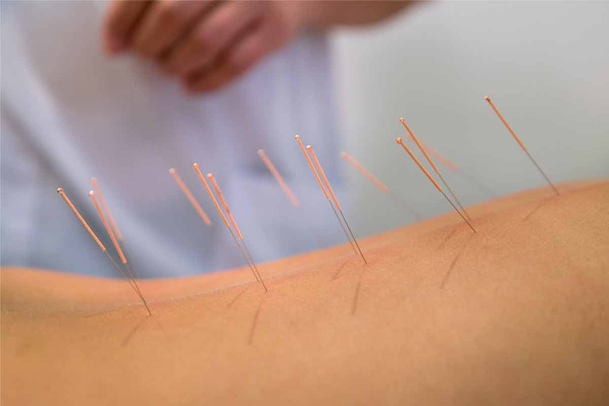 Treatment by acupuncture