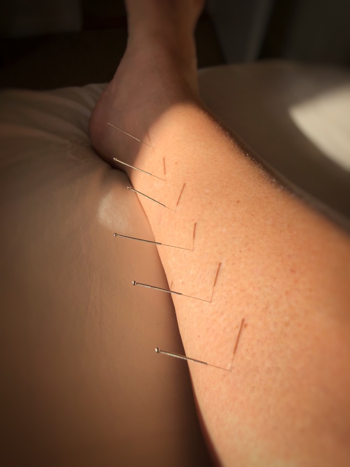 Acupuncture needles in human leg